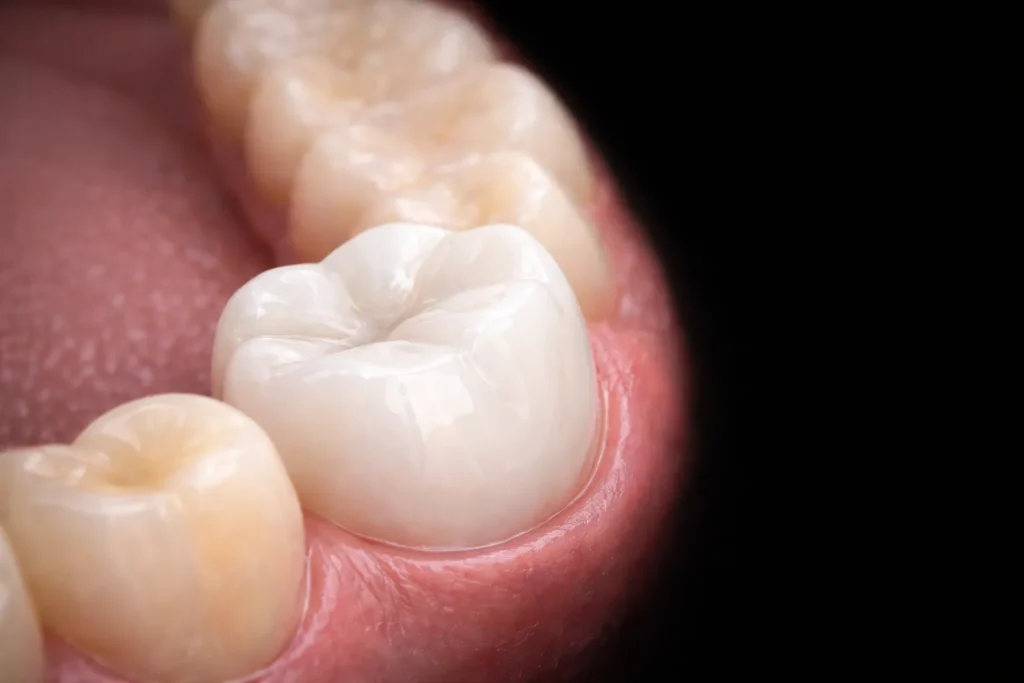 شكل طربوش الاسنان البورسلين