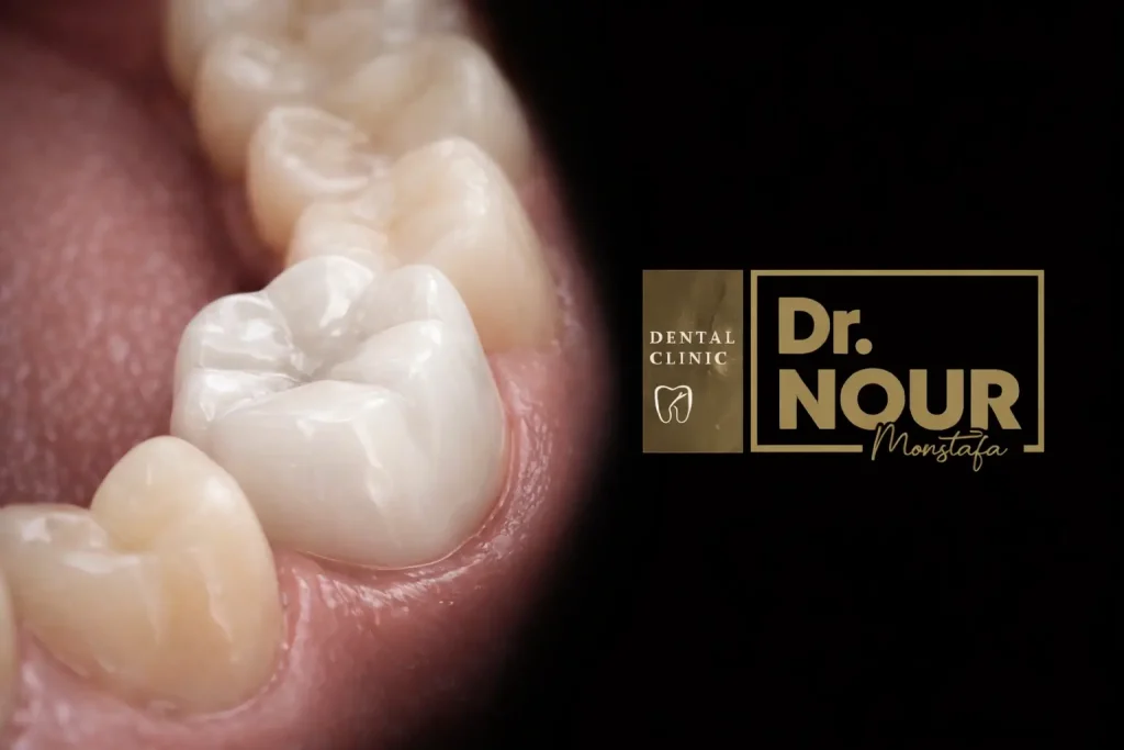 شكل طربوش الاسنان الراتنج