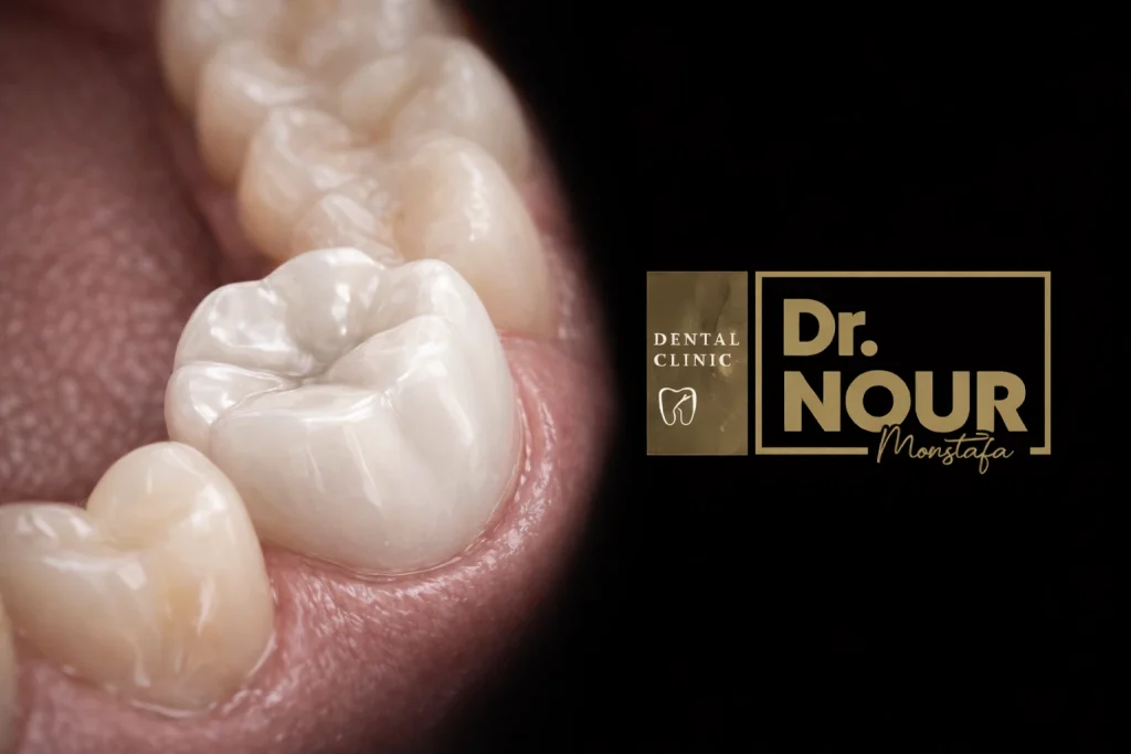 شكل طربوش الاسنان الزيركون.دكتور نور