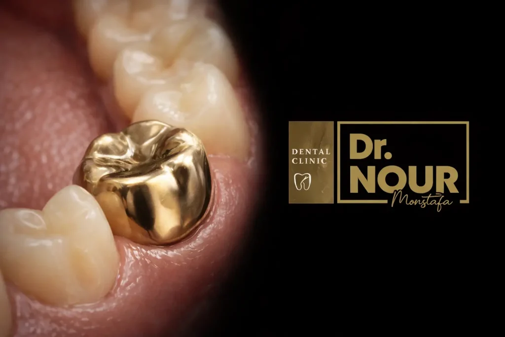 شكل طربوش الاسنان المعدني