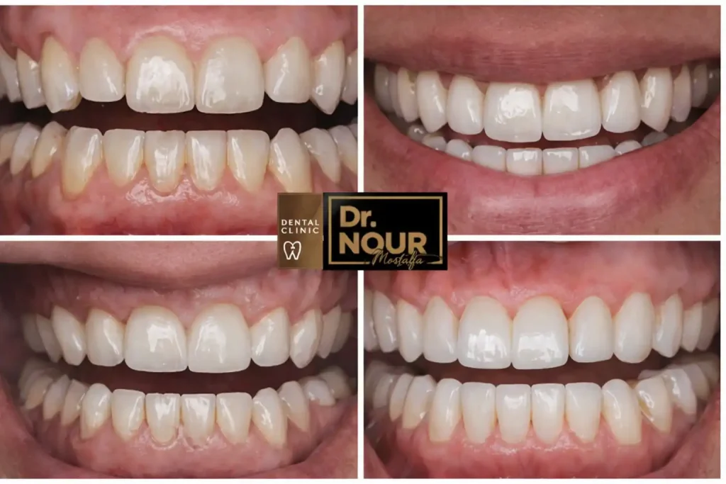 تركيب الاسنان البورسلين بالصور