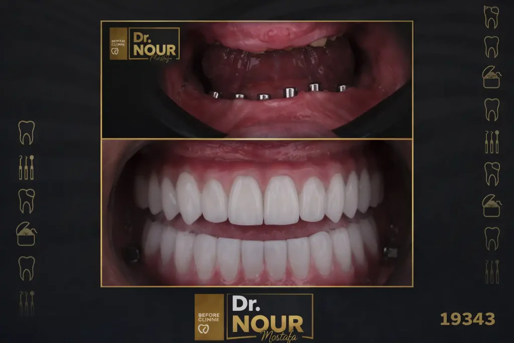 زراعة الاسنان قبل وبعد بالصورر