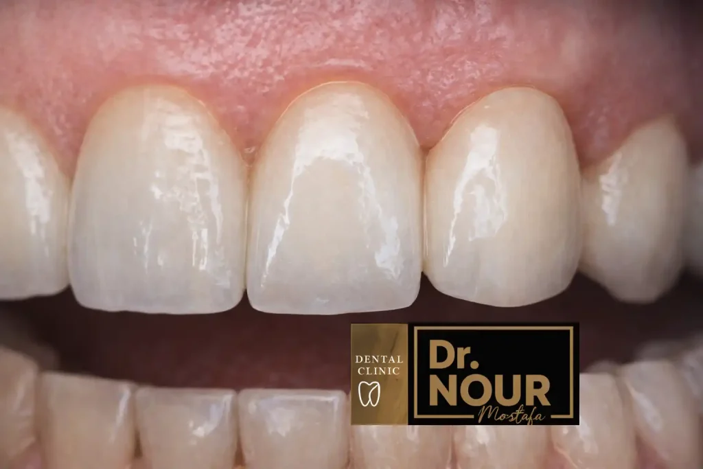 شكل طربوش الاسنان البورسلين- مركز وايتي دينتال