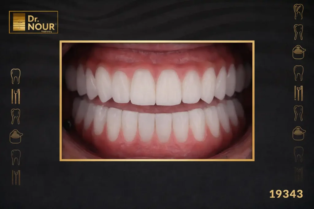 مراحل زراعة الأسنان بالصورر